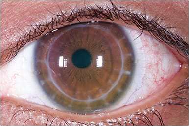 Figure 1. Patients using scleral lenses can have their treatment complemented with immunomodulators, autologous serum drops, or punctal plugs.Photo courtesy of Dr. Melissa Barnett and Dr. Lisa Hornick.