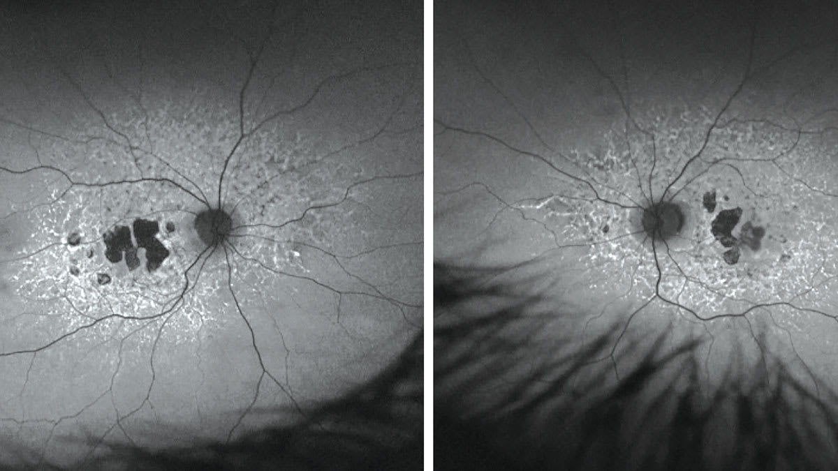 Figure 1. Fundus autofluorescence imaging was inconsistent with age-related macular degeneration.  Note the symmetric hyperFAF branches and flecks that are paramacular and extending beyond the vascular arcade of the posterior pole. (Photo courtesy: Dr. Legge)