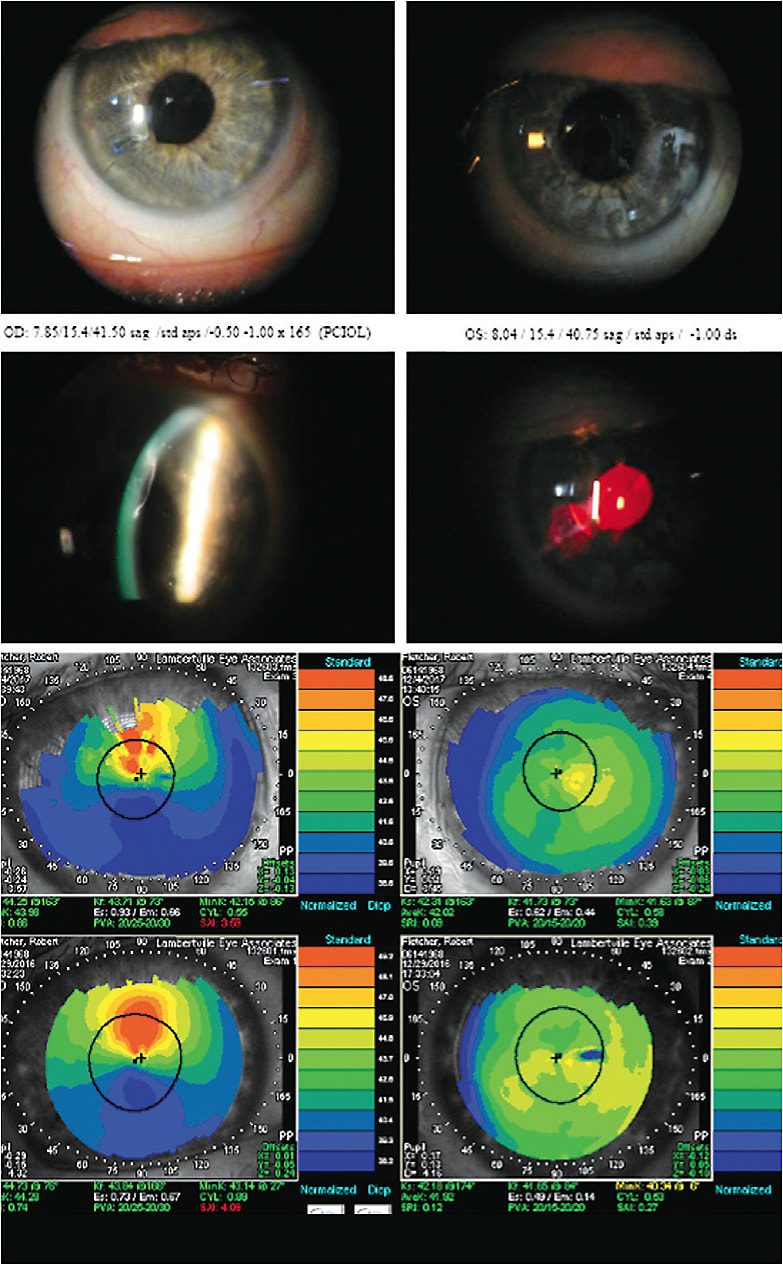 Weed whacker penetrating corneal injury required a scleral lens fit.