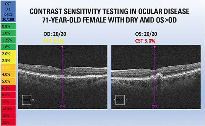 This patient has subtle drusen in the right eye and more prominent drusen in the left, as seen by OCT. Though VA remains 20/20 in each eye, asymmetric contrast sensitivity testing reveals visual impairment in the left eye. Image courtesy of Dr. Mark Roark.