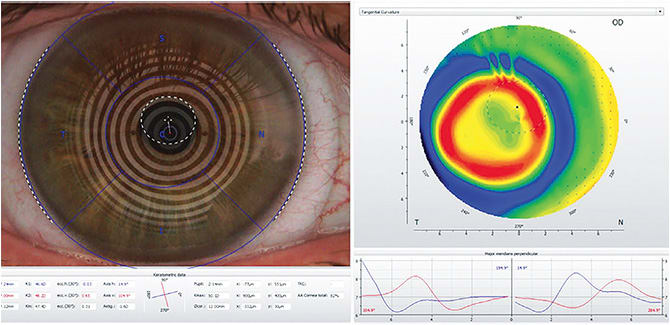 Note the centration of this center-distance multifocal scleral lens over the cornea. Over-topography shows that the placement of the add zone is inferior temporal to the visual axis and pupil. Photo courtesy of Dr. Susan Resnick.