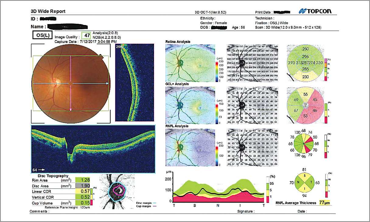 Wide-field OCT scan of patient at Dr. Bazan’s practice revealed pallor on the optic nerve head, a sign of optic neuritis.
Courtesy of Justin Bazan O.D.