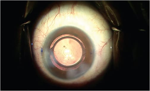 TECNIS Symfony EDOF IOL
Courtesy of Cecelia Koetting, O.D., F.A.A.O.