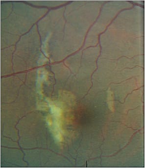 Example image of a choroidal rupture. Courtesy of Sherrol A. Reynolds, O.D., F.A.A.O.