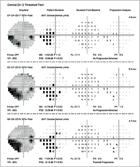 Note the deepening and enlargement of the existing defect confirms suspected progression.Image courtesy of Dr. Austin Lifferth.