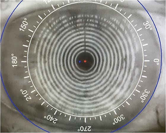 Preoperative topography image shows irregular mires due to  poor tear film resulting from dry eye disease.
Images courtesy of Marjan Farid, MD