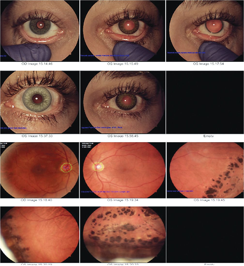 Paintball injury with resultant aniridia. An aphakic, retinal detachment requires treatment. This patient ultimately received a prosthetic cosmetic contact lens.