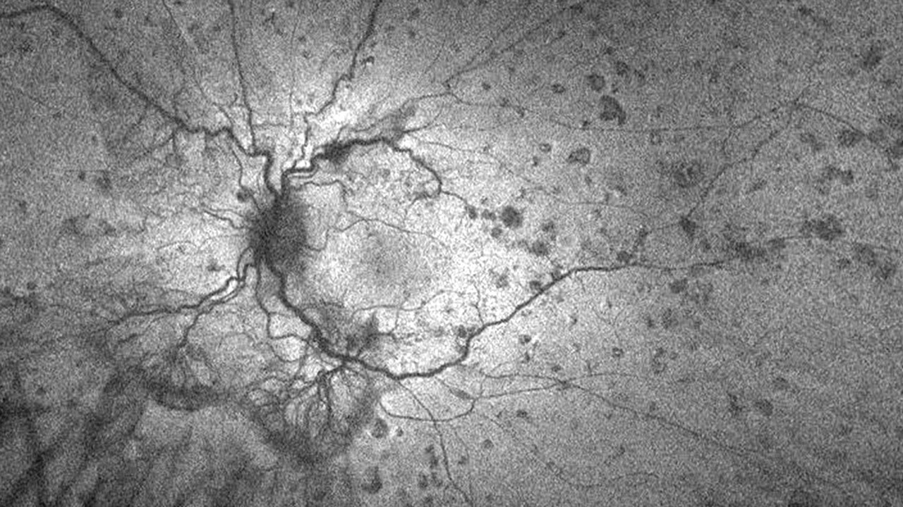 Diabetic retinopathy is an ocular manifestation of diabetes ODs know all too well. (Photo courtesy: Dr. Tonya M. Reynoldson)