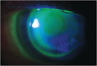 A hybrid lens on a post radial keratotomy patient.
Photos courtesy of Dr. Stephanie Woo.