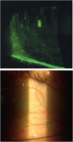 Utilize the two-dye system (lissamine green, top, and NaFl) to look for ocular surface irritation.
Images courtesy of Dr. Jason Miller