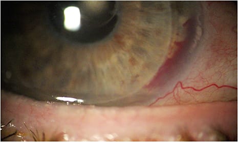 Note the post-stent hyphema in this patient at one-day post-op. Photo courtesy of Dr. Justin Schweitzer.
