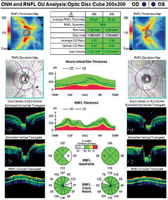 Figure 1. OCT shows this patient falls under OHTS demographics. 
Images courtesy of Dr. Austin Lifferth