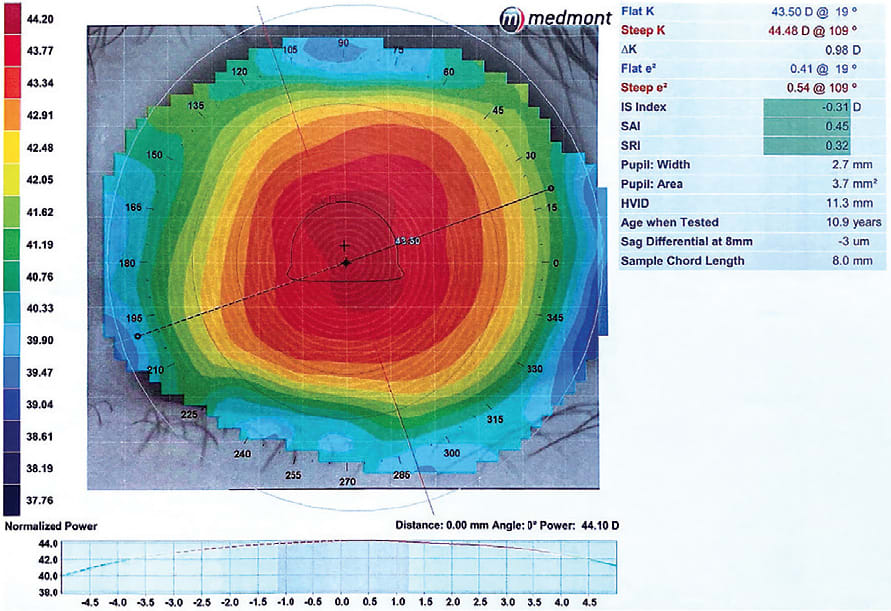 Topography results shown above verify ortho-k lens placement. Image courtesy of Dr. Jason Miller