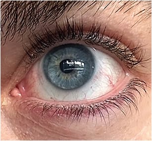 Note the scleral CL’s large diameter.Photo courtesy of Dr. Kevin Patrizio.