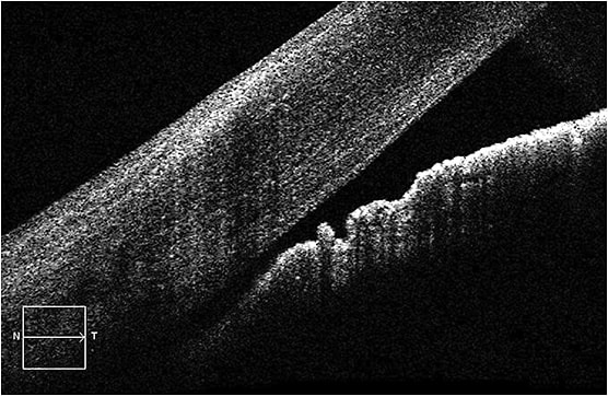 Narrow angle glaucoma, as viewed by OCT.
Image courtesy of Steven M. Bloom, M.D.