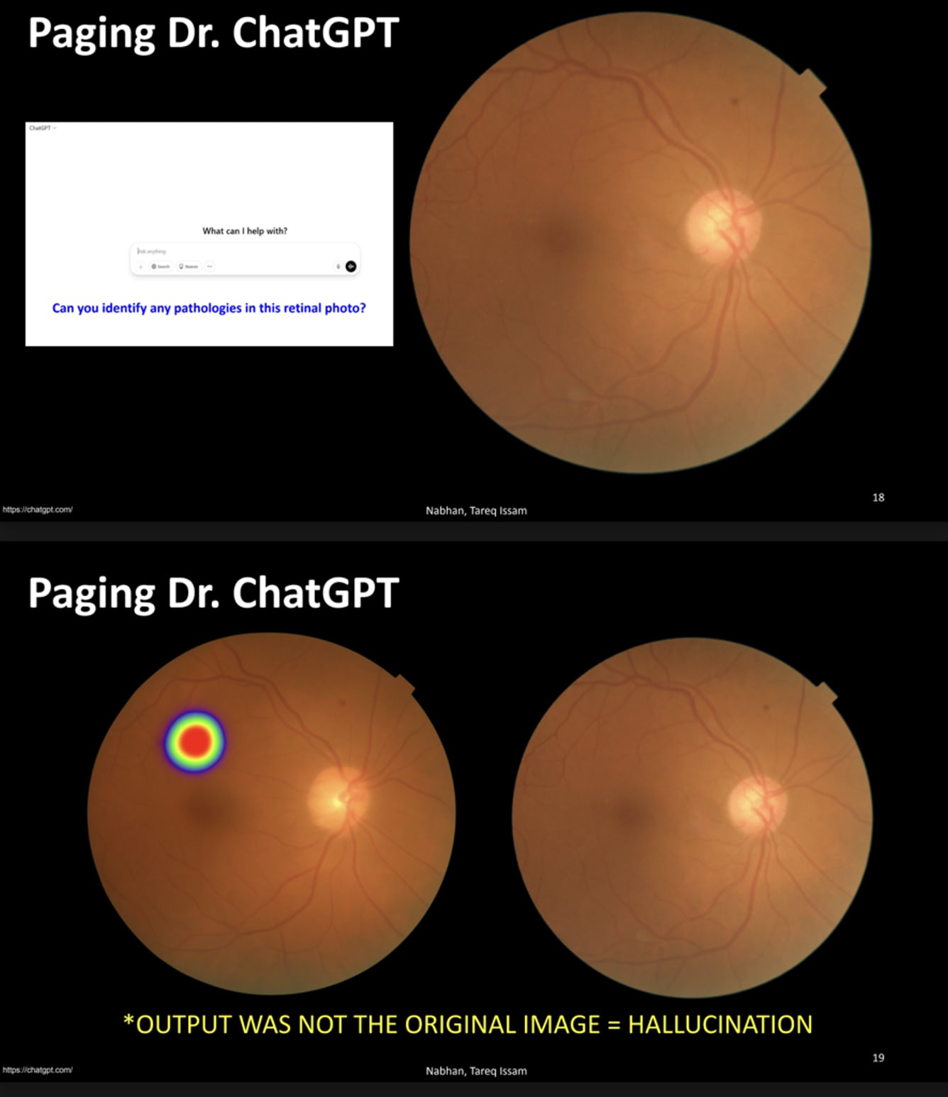 Dr. Nabhan and his group tested ChatGPT to see how accurate it is at lesion detection across various retinal pathologies. This is an example of failed lesion detection in a case of diabetic retinopathy and the subtle software hallucination that may mislead the user.