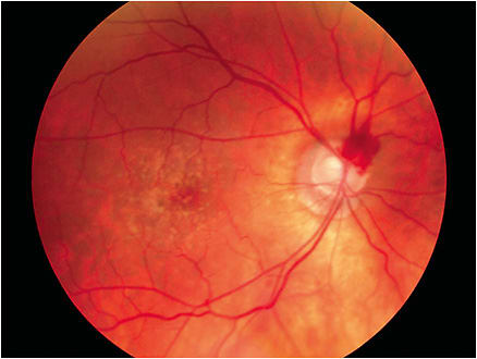 Optometry is the provider of about 70% of all primary care examinations, placing optometry as the gateway for the identification of glaucoma.
Image courtesy of Steven M. Bloom, M.D.