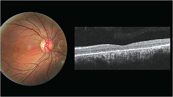 Note the increased choroidal thickness in the color photograph and EDI-OCT image. 
Photo courtesy of Sherrol A. Reynolds, O.D., F.A.A.O. &amp; Marlon Demeritt, O.D., F.A.A.O., M.B.A.