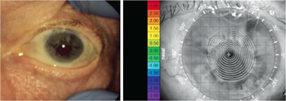 Rose thorn-penetrating OS. PKP aphakic, ectopic pupil, requires scleral lens. All images courtesy of Dr. Kenneth Daniels.