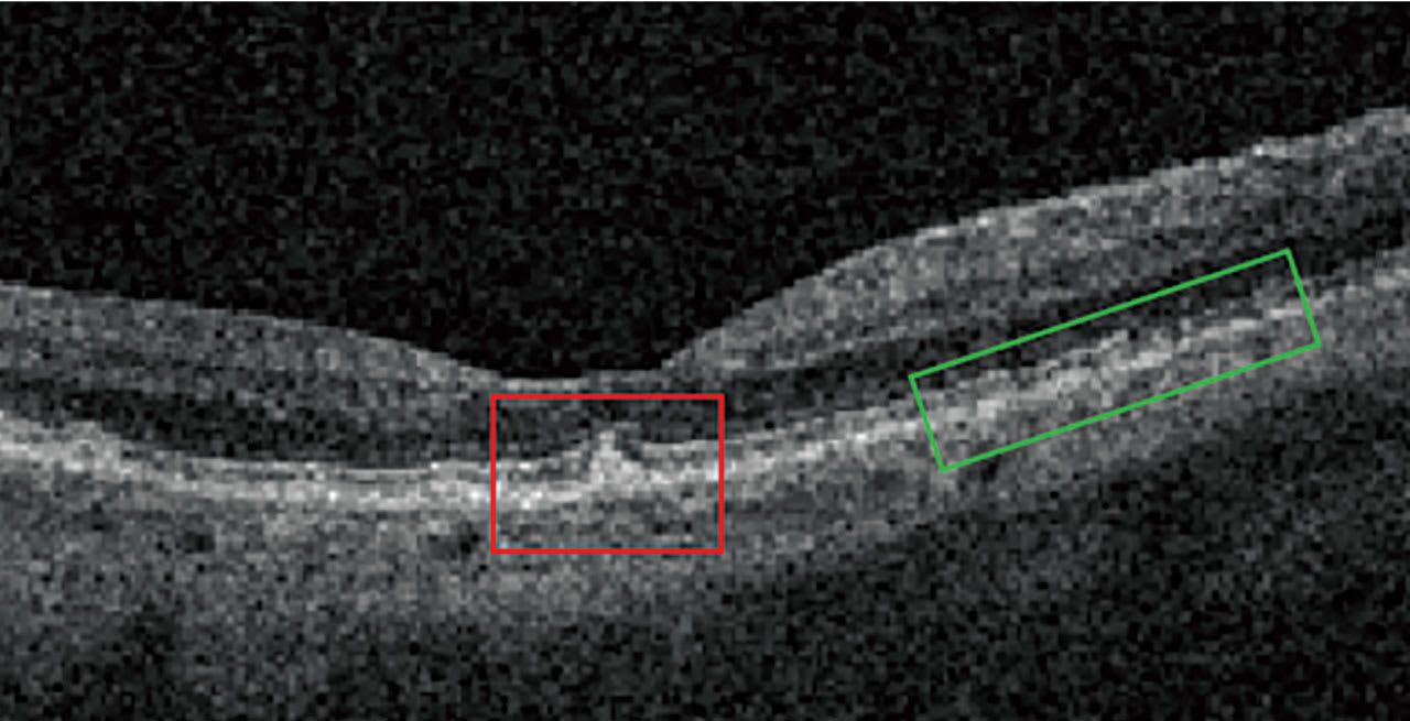 Figure 3. Note this OCT image showing subretinal drusenoid deposits. Red Box: subretinal drusenoid deposit (SDD) disrupting the ellipsoid zone and external limiting membrane. Green Box: disruption of the RPE. (Photo courtesy: Dr. Kinzer)