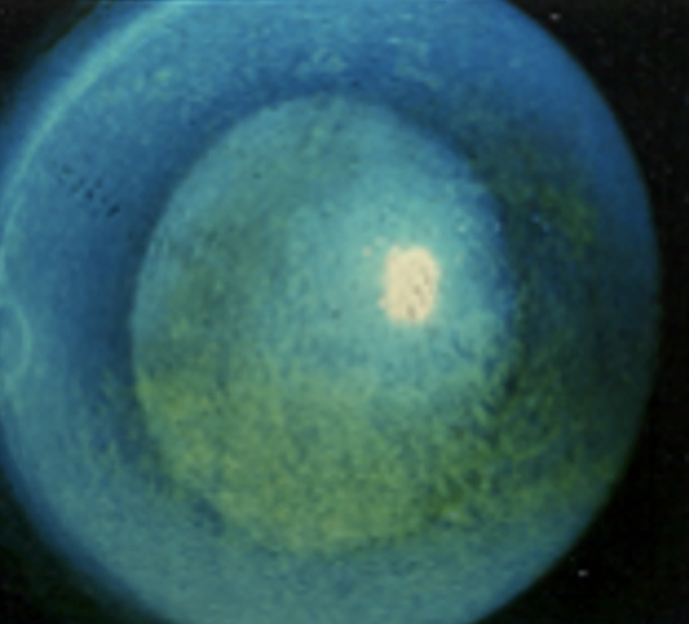 Note the corneal fluorescein staining in this severe dry eye disease patient. (Photo Courtesy: Joseph P. Shovlin, OD, FAAO)