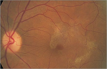 OS: Pre-operative image demonstrating the ERM with pseudomacular hole.
Courtesy of Sherrol A. Reynolds, O.D., F.A.A.O.