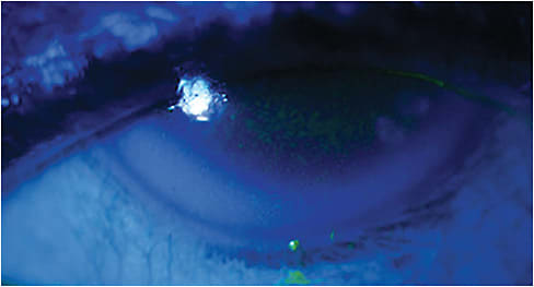DED with diffuse punctate epithelial and filamentary keratitis is shown.
Image courtesy of Dr. Josh Johnston