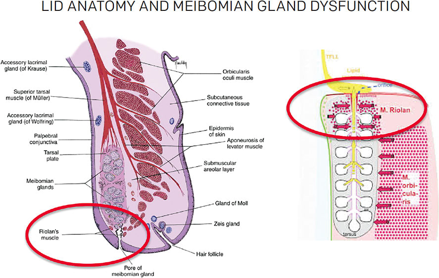 Figure 1. Riolan’s muscle prevents the meibomian glands from releasing lipid until the eyelids touch during a blink. Spent tears are sucked out of the system and lipid is metered out in a concise amount.