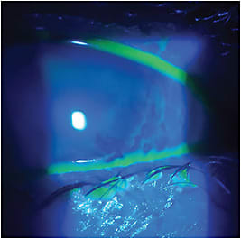 Corneal and conjunctival edema secondary to chronic contact lens overwear.
Photo courtesy of Jade Coats, O.D.