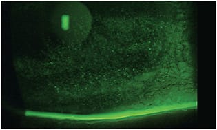 Staining of 16-year-old patient who experienced blurred vision as a result of a moderately dry ocular surface with inferior superficial punctate keratitis. 
Image courtesy of Dr. Jason Miller