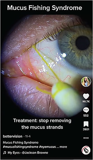 A TikTok video posted by Dr. Brittani Carver-Schemper describes mucus fishing syndrome and its consequences for the eye.Image courtesy of Dr. Carver-Schemper