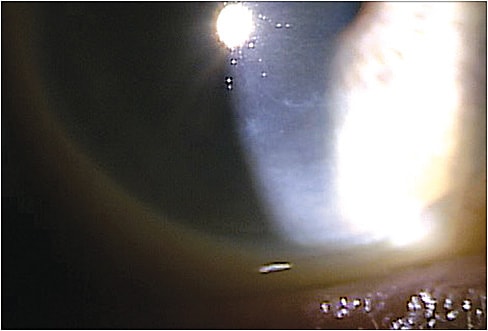 Note: the map-like lines in this cornea with EBMD.
Courtesy of Savannah Brunt, O.D.