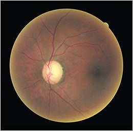Fundus image of the patient from the Avanti Widefield OCT.
Courtesy of Julie Rodman, O.D.