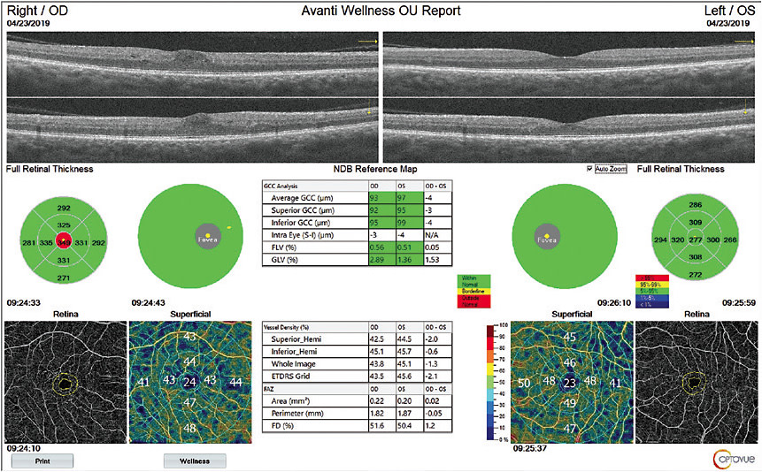 Retinal and vascular images, via AngioWellness. 
Image courtesy of Dr. Greg Caldwell