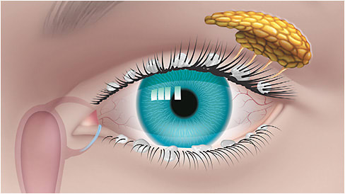 Management of most cases of DED requires only a systematic approach and an understanding of the vicious disease cycle.
stock.adobe.com
