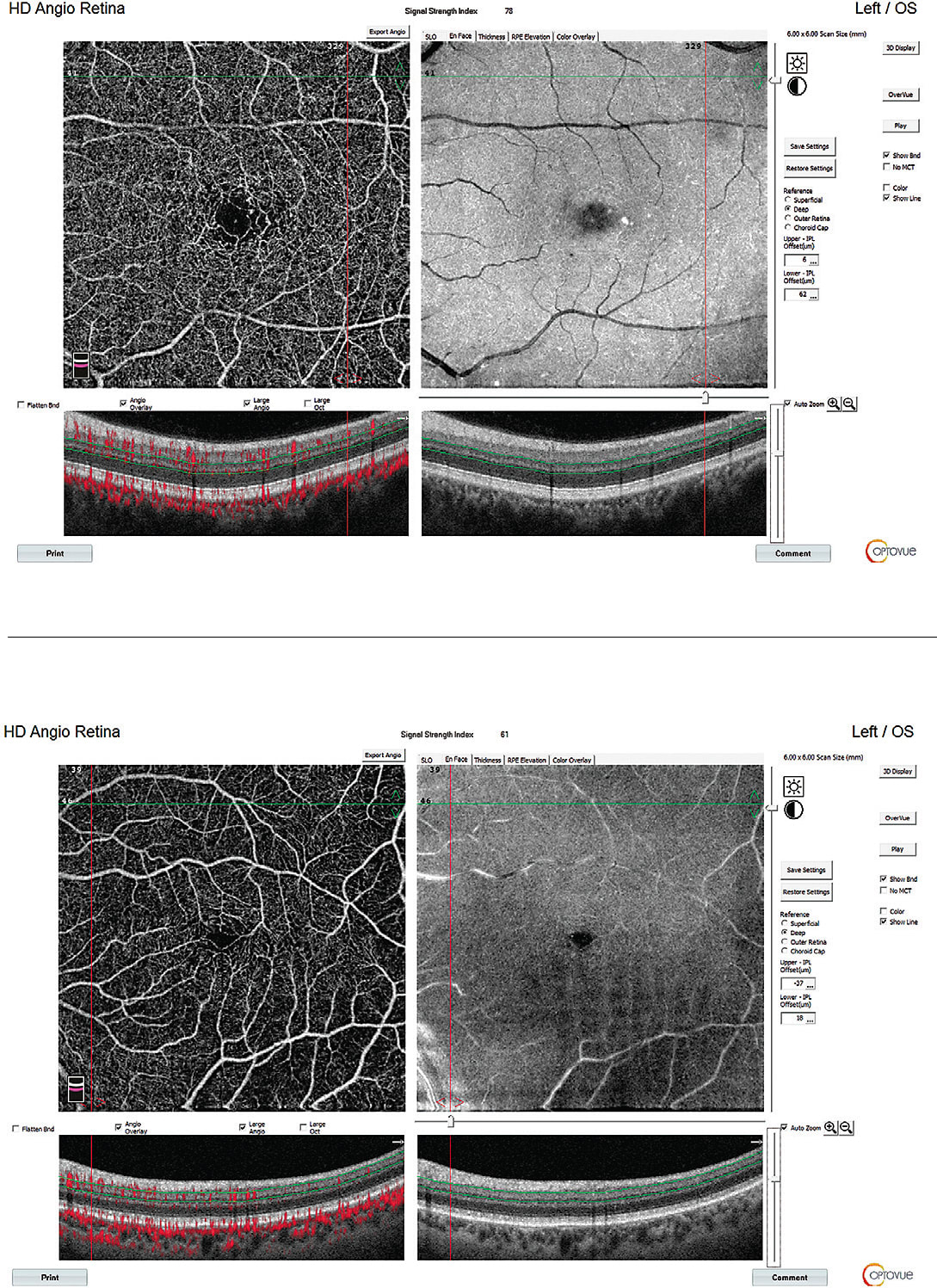 The abnormal DM (top) eye shows: a foveal avascular zone (FAZ) that is expanding, areas of capillary dropout and microaneurysms, which is not able to be seen with a dilated fundus exam and with a traditional retina OCT. 
Courtesy: Gregory Caldwell, O.D., F.A.A.O.