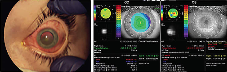 Alkaline burn OS requiring Descemet stripping automated endothelial keratoplasty to recover vision.