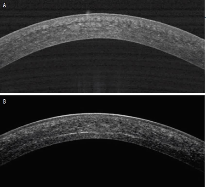 Optical coherence tomography before epi-off crosslinking (CXL) procedure, at top, and 6-weeks post-CXL showing tissue changes, at bottom. (Photo courtesy of Dr. Resnick)