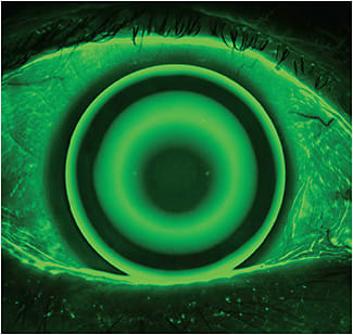 Orthokeratology has been used as a method to correct myopia for more than 50 years.Image courtesy of Randy Kojima
