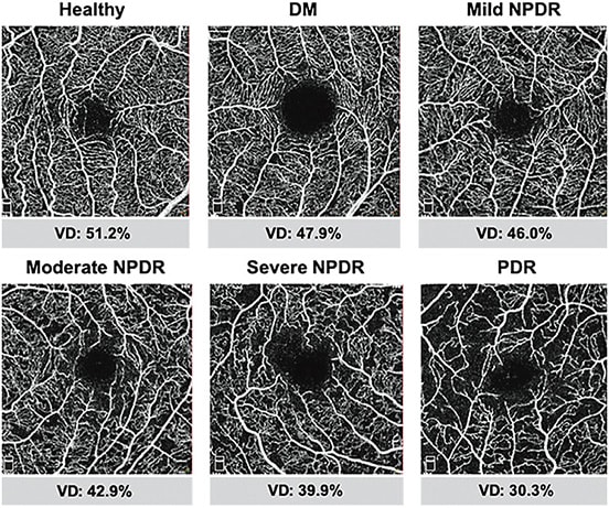 These images, from a review by Moir et al, show the decreasing vascular density measurements in patients who have diabetes sans retinopathy, and patients with increasing severity of DR seen on OCT-A.Image attribution: Moir, J., Khanna, S., &amp; Skondra, D. (2021). Review of OCT angiography findings in diabetic retinopathy: Insights and perspectives. International Journal of Translational Medicine, 1(3), 286–305. https://doi.org/10.3390/ijtm1030017. Image used via open access under the Creative Commons Attribution License.