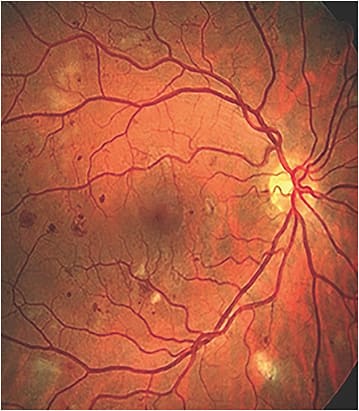 Note this patient’s non-proliferative diabetic retinopathy and CSME.
