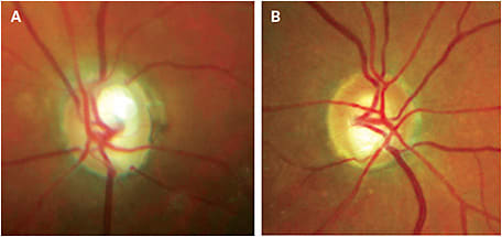 Patient’s ONH photo: 0.75 OD and 0.7 OS with an inferior notch
Images courtesy of Sherrol A. Reynolds, O.D., F.A.A.O.