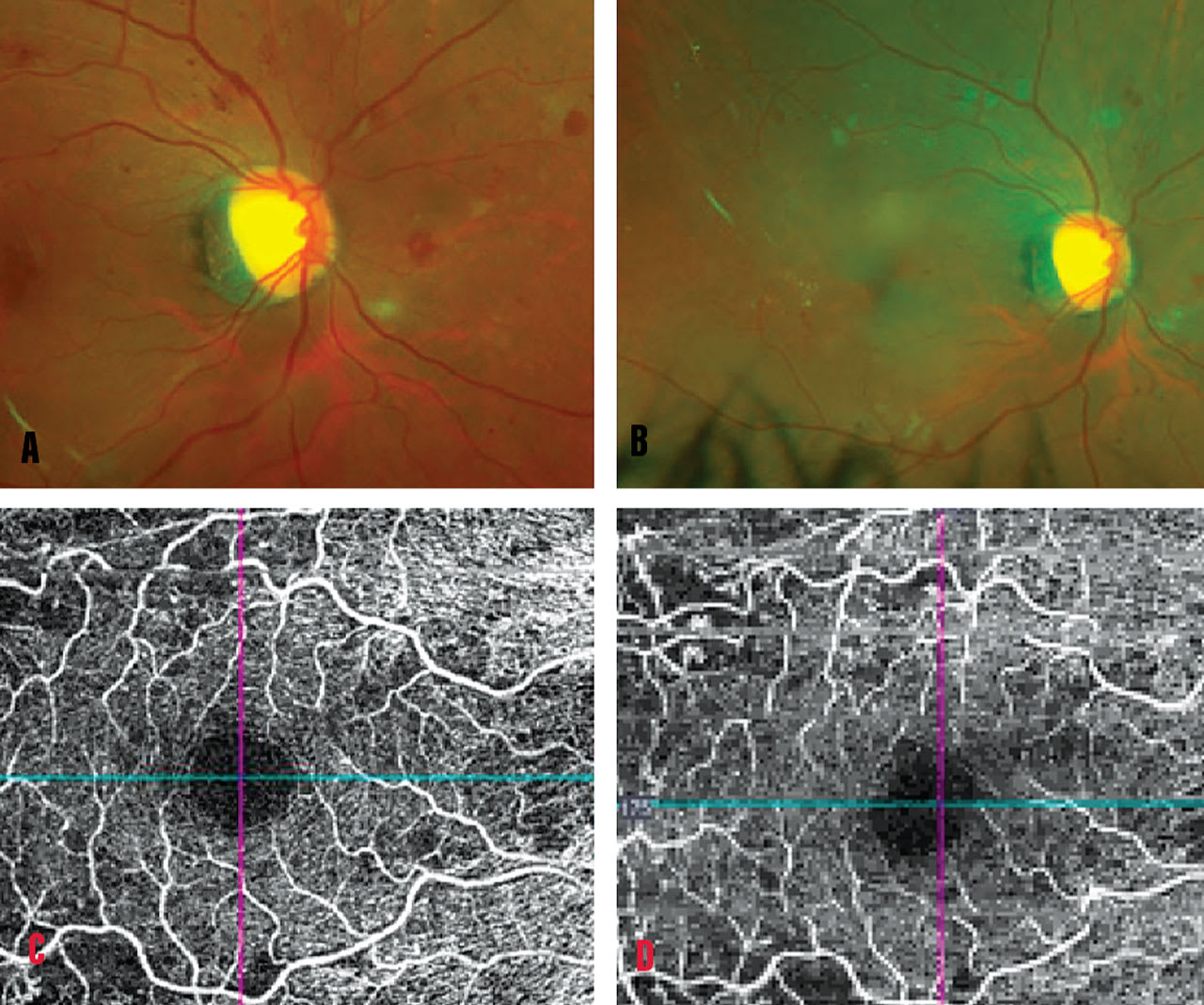 This patient with type 2 diabetes had (A) moderate-severe nonproliferative DR on initial visit OD. Optical coherence tomography-angiography (OCTA) (B) showed ischemia and vascular looping.  At 3-month follow-up, the patient reported taking a GLP-1 agonist. Note the worsened DR (C) with increased wool spots  and stable OCTA findings.
