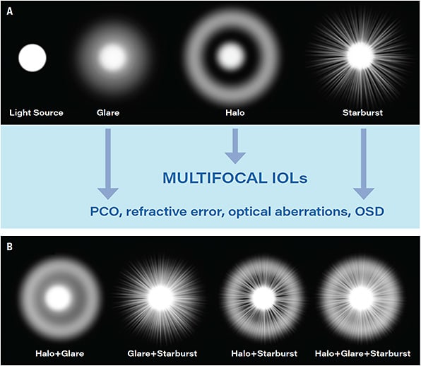 Figure 1. (A) Sources of positive dysphotopsias. (B) Combination of sources of positive dysphotopsias.