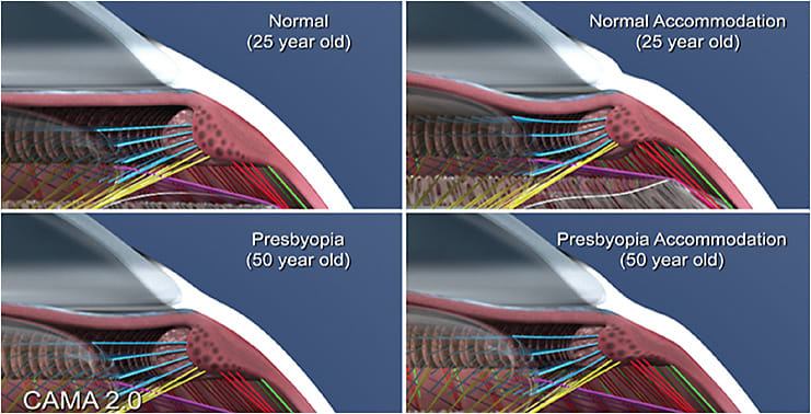 Figure 5. Still image from an animation of accommodation showing scleral movement (right). Image from 13.