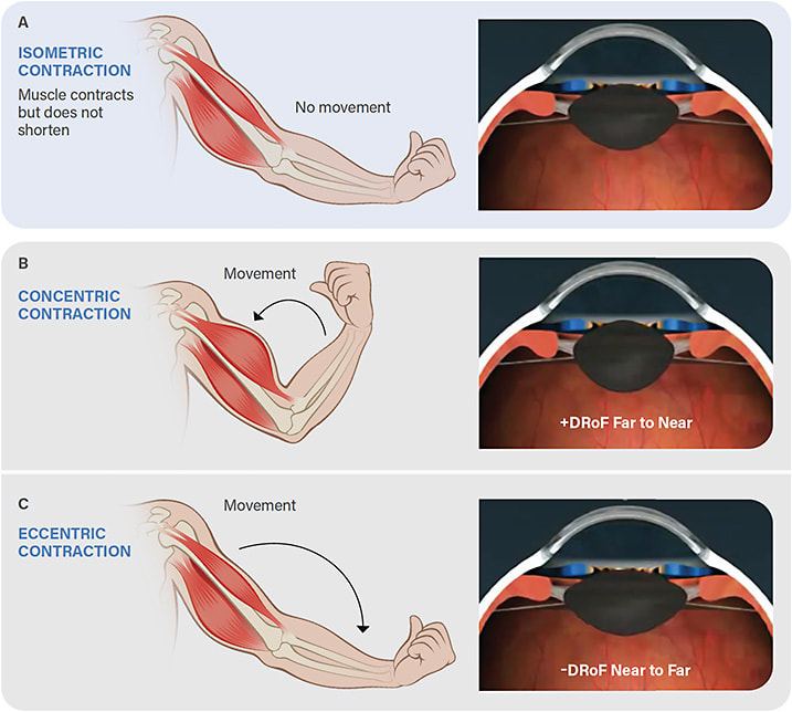 Figure 1. Concentric, isometric, and eccentric contractions of the biceps muscle. Similarly, the ciliary muscle can undergo concentric, isometric, and eccentric contractions. Images from https://antranik.org/the-three-phases-of-movement/ and https://gfycat.com/menacingsophisticatedelkhound .