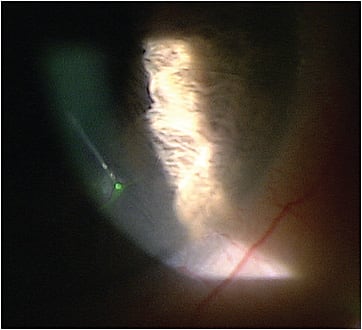 Figure 1. RK incision complication.