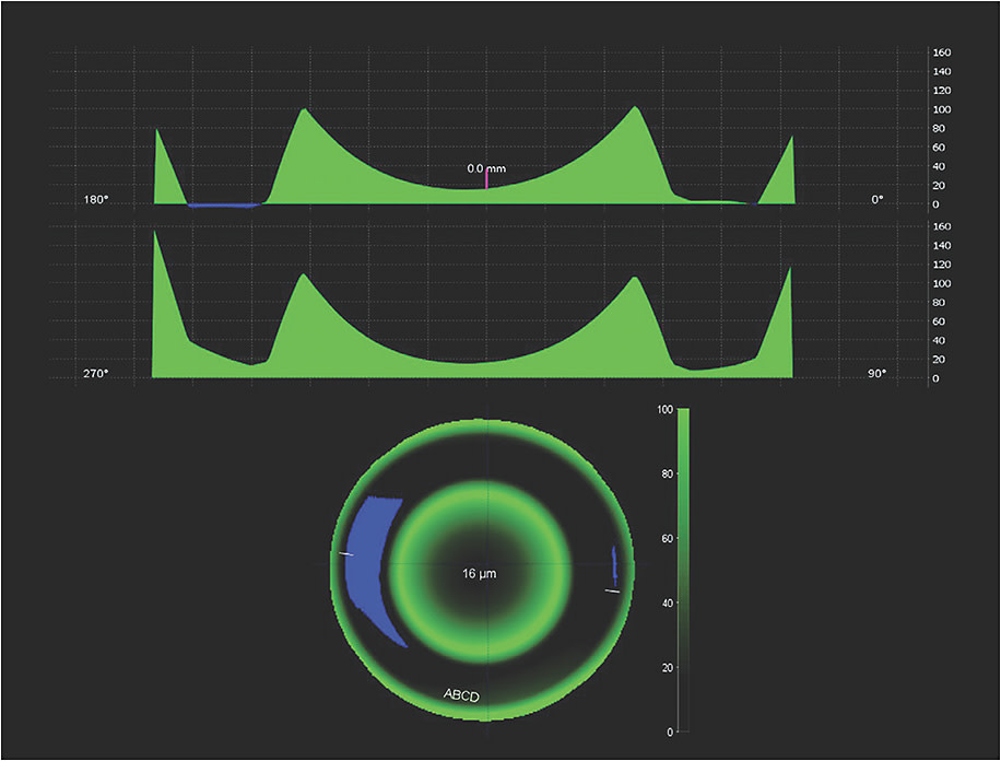 Figure 6. Ortho-k design software linked to corneal topography is also available when a high degree of customizability is desired.
