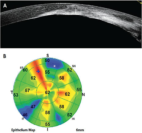 Figure 4. Patient who has a corneal injury. (A) Optical coherence tomography cross-section of the cornea. (B) An epithelial thickness map, which is highly irregular in this patient.