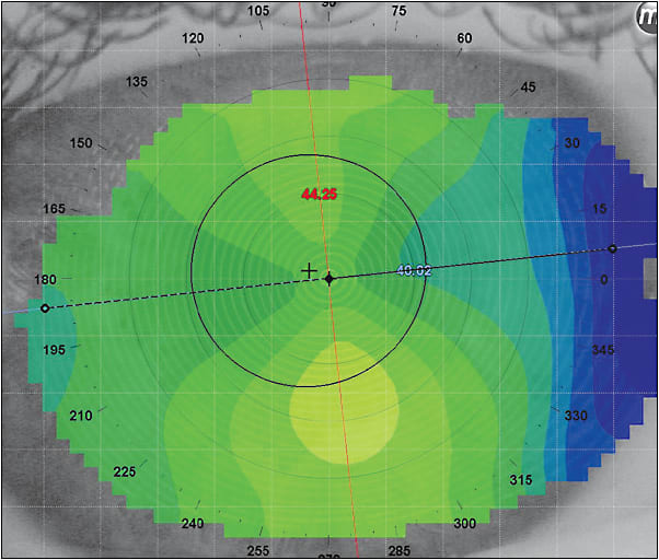 Figure 1. Children who have limbus-to-limbus high astigmatism can be corrected with GP lenses.